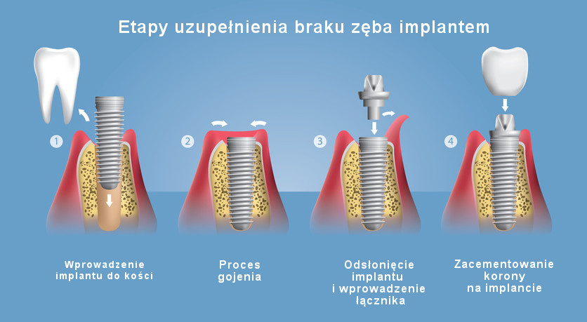 Implanty OptimDent