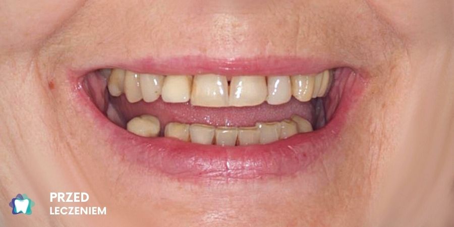 Dentysta Przed Implantami